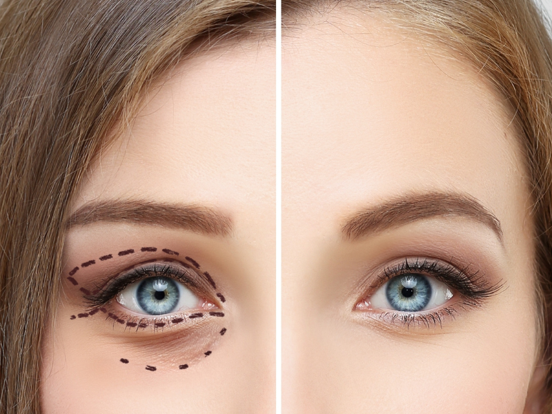 What’s the Best Time to Consider Blepharoplasty?