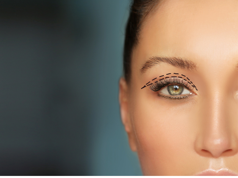 What to Expect Before, During, and After Blepharoplasty Surgery